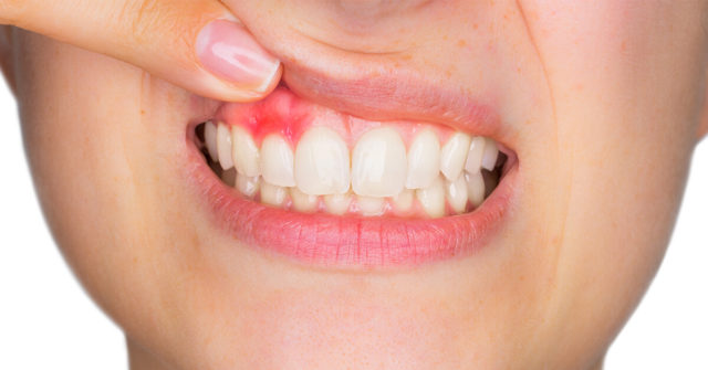 5 Most Common Causes of Gum Bleeding