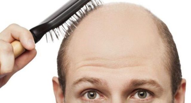 hair transplant